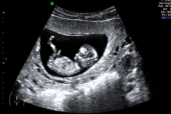 سونوگرافی تعیین جنسیت سونوگرافی تعیین سن بارداری و جنین در
