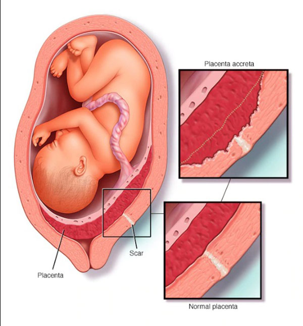 جقت و جنین در بارداری
