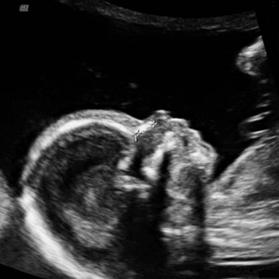سونوگرافی در سه ماهه دوم بارداری