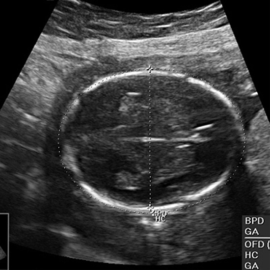 سونوگرافی در سه ماهه دوم بارداری
