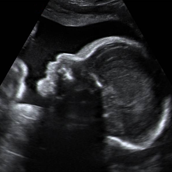 سونوگرافی سه ماهه دوم بارداری