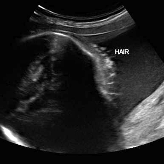 سونوگرافی در سه ماهه سوم بارداری