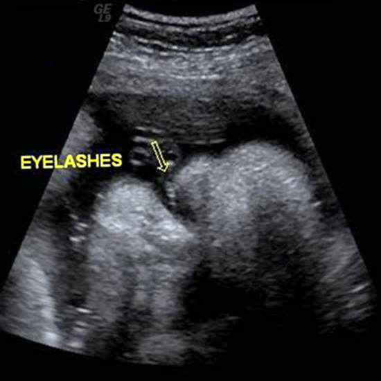سونوگرافی سه ماهه سوم بارداری
