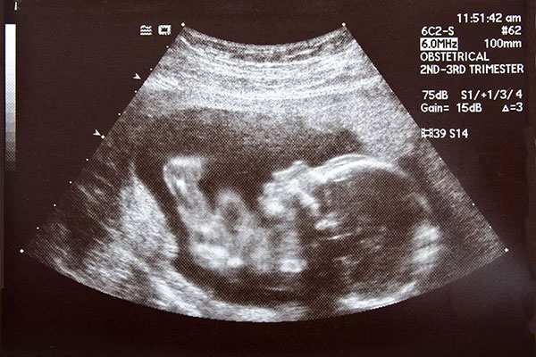 آیا سونوگرافی برای جنین بی خطر است؟