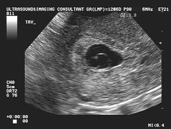 سونوگرافی هفته پنجم بارداری