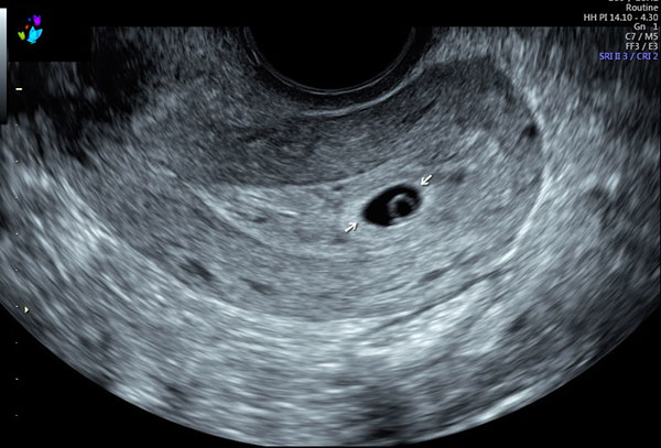 سونوگرافی هفته پنجم بارداری