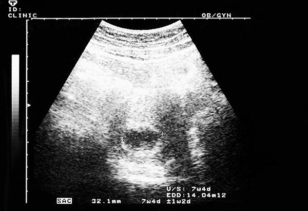 سونوگرافی هفته هفتم بارداری