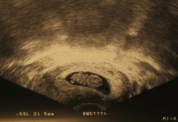 سونوگرافی هفته هشتم بارداری