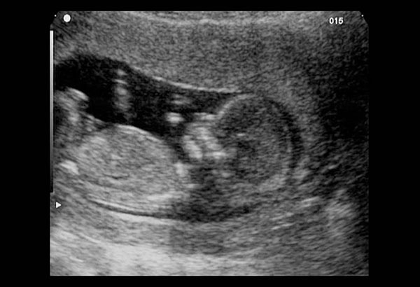 سونوگرافی هفته دوازدهم بارداری