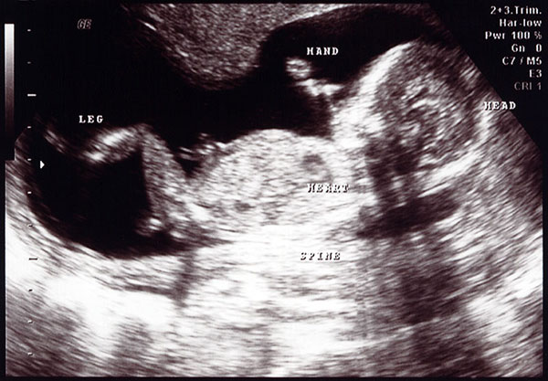 سونوگرافی هفته هفدهم بارداری