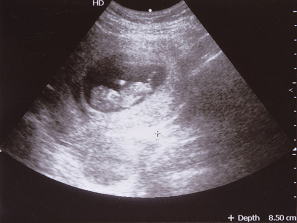 ضربان قلب جنین در سونوگرافی