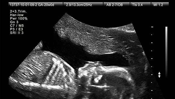 سونوگرافی هفته بیستم بارداری